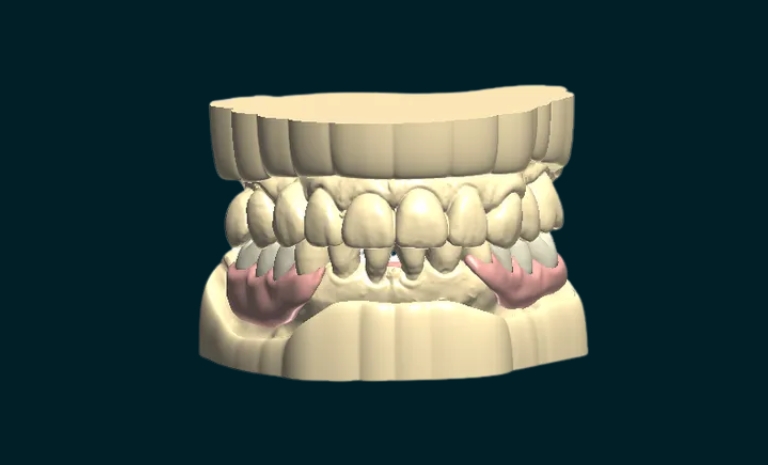 Flexible Partial Denture
