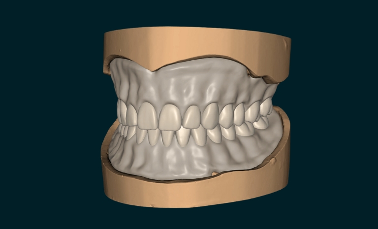 Full Denture
