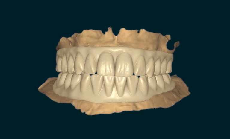 Full Mouth Rehabilitation